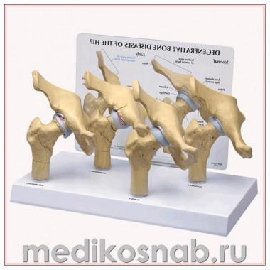 Модель дегенеративных заболеваний костей тазобедренного сустава (4 стадии) 