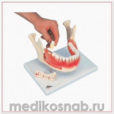 Модель болезней зубов