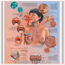 Плакат медицинский ХОЗЛ - хроническое обструктивное заболевание легких