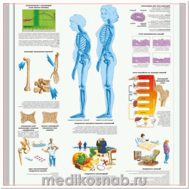 Плакат медицинский Остеопороз