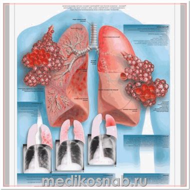 Плакат медицинский Пневмония