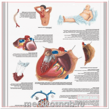 Плакат медицинский Распространенные сердечные заболевания