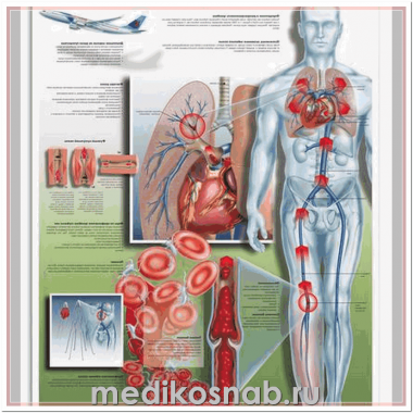 Плакат медицинский Тромбоз глубоких вен