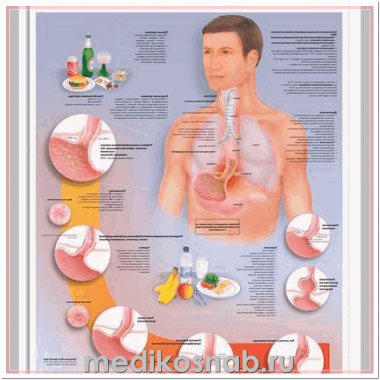 Плакат медицинский Желудочно-пищевой рефлюкс
